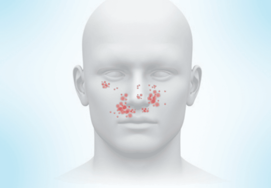 Location of facial angiofibroma