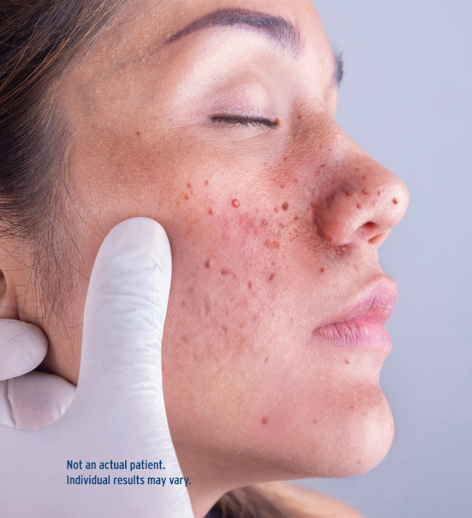 treatment-challenges Facial angiofibroma patient image