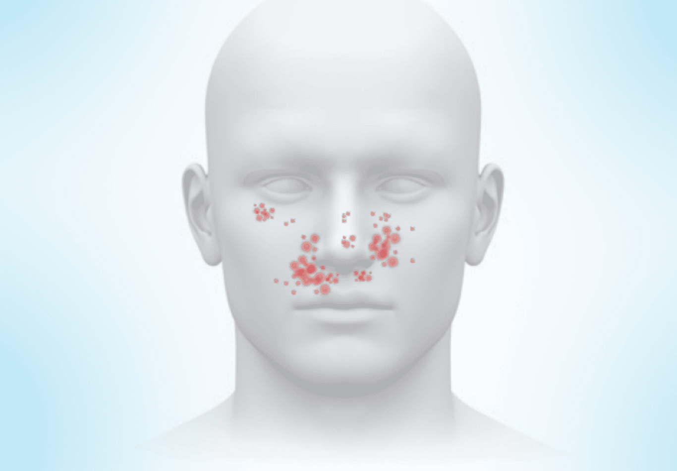 TSC_affects Image of Facial Angiofibromas reddish bumps on the face