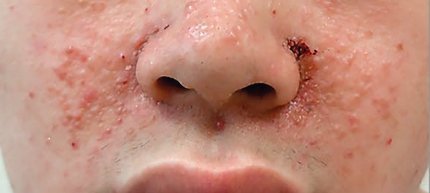patient-after Face photo of Facile Angiofibromas young boy patient who use after HFYTOR in 12 weeks